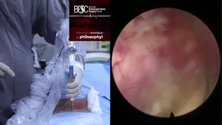 HOW TO HOLD SPINE ENDOSCOPE?