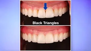 Solution for those horrible Black Triangles!