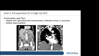 UROwebinar: Developments in perioperative immunotherapy for bladder and kidney cancers