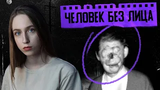 ЖУТКАЯ ИСТОРИЯ ЧЕЛОВЕКА БЕЗ ЛИЦА | Рэймонд Робинсон | Зеленый человек