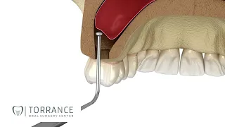 Torrance Sinus Augmentation for Dental Implants | Redondo Beach Sinus Lift