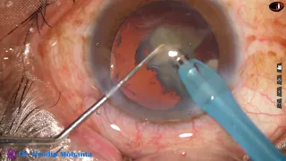 Management of a hard cataract - unedited video - Pradip Mohanta, 18th January, 2022