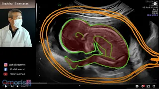 ULTRASOUND: confirming FETAL SEXING. Pregnancy 18 weeks.