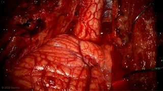 Far Lateral Craniotomy for In Situ Occlusion of a Ruptured Posterior Medullary AVM