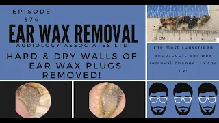 HARD & DRY WALLS OF EAR WAX REMOVED - EP 374