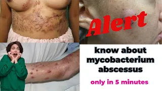 mycobacterium microbiology lecture ||Mycobacterium abscessus ||Easy Microbiology #microbiology