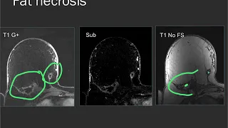 Breast MRI - common findings and cases