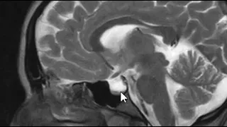 Pseudotumor Cerebri - Brain Scan MRI