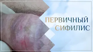 Первичный сифилис. Клинический случай №2