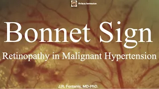 Bonnet Sign. Retinopathy in Malignant Hypertension.