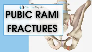 Pubic Rami Fractures | What are they? How do you treat them?