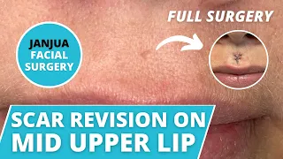 SCAR REVISION ON LIP FROM INVOLUTED CYST - DR. TANVEER JANJUA - NEW JERSEY