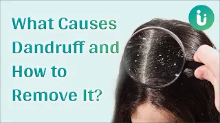 What actually causes Dandruff and how can you get rid of it?