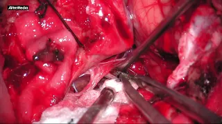 Foramen Magnum Meningioma exision - Far lateral approach