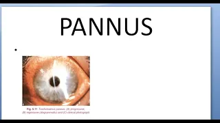 Ophthalmology Pannus Progressive Regressive Total Corneal Blinding Sequalae Difference Causes