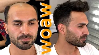 PROTEZ SAÇ NASIL YAPILIR ? - Hair Replacement