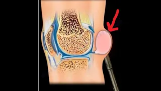 Baker's Cyst, its relationship to meniscus tears and  knee arthritis