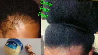 HOW TO USE VASELINE & GINGER TO GROW HAIR 2CM PER DAY VERY FAST HEALTHY HAIR GROWTH