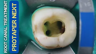 Root Canal Treatment in Mandibular Molar ⚪️ Protaper Next 🔵 Step By Step Demonstration