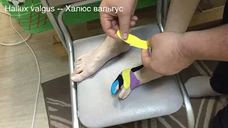 Тейпирование при боли в косточке на ноге.  Hallux valgus    Халюс вальгус