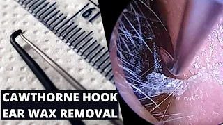 Cawthorne Hook Used To Extract Rock Hard Ear Wax