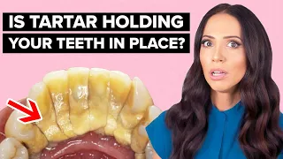 Is Tartar HOLDING Your Teeth In Place? (Calculus Bridge Explained)