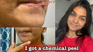 I got a chemical peel for acne scars|| Skin peeling || Experience