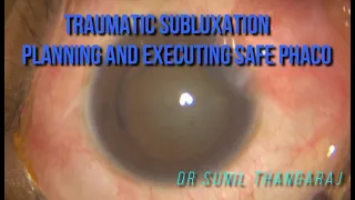 Traumatic subluxation - planning and execution of successful phacoemulsification with IOL