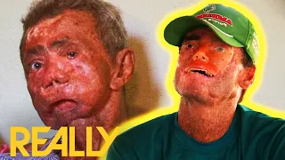 Brazilian Villagers Suffer From Rare Condition Causing Skin To ROT In The Sun | Body Bizarre