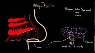 What is Allergic Rhinitis?