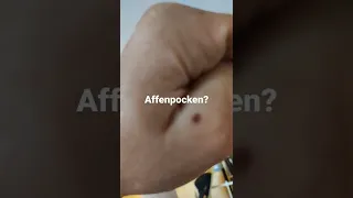 Affenpocken