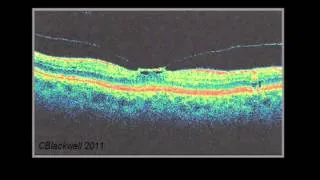 Vitreous 2: Vitreous and Trouble