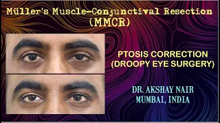 Ptosis Surgery -  Müller's muscle-conjunctival resection: Dr Akshay Nair, India