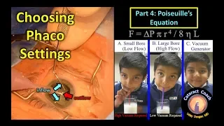 Phaco Fundamentals Part 4: Poiseuille's equation for fluidics in cataract surgery