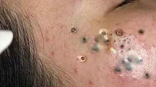 Blackheads Extraction Whiteheads Removal Pimple Popping #2824
