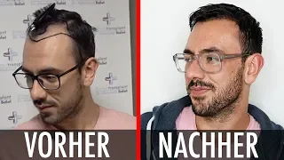 Haartransplantation VORHER NACHHER #5 ● Haartransplantation Türkei nach 6 Monaten