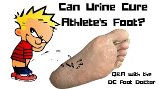 Can Urine Cure Athlete's Foot?