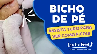 Retirada de Bicho de Pé - COMPLETA!