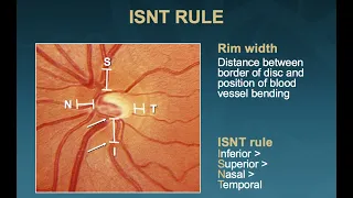 The 5 Rs of Examining the Optic Disc (Malik Y. Kahook, MD)