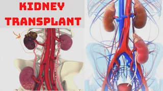 Kidney Transplant - How serious is a kidney transplant? - Side effects of a kidney transplant?