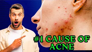 The #1 Vitamin Deficiency with Acne