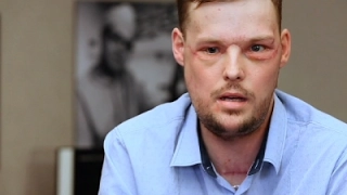 Face Transplant Links Men Touched by Tragedy