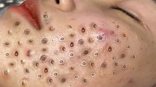 Blackhead Removal With Sac Dep Spa @10007070