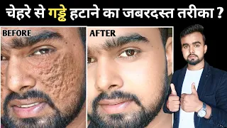 चेहरे से गड्ढे हटाने का जबरदस्त तरीका | Chehre Ke Gadde Kaise Bhare | Acne Scar Treatment