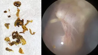 117 - Completely Blocked Ear with Dry Ear Wax & Dead Skin Cleaned with WAXscope®️