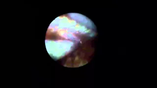 Endoscopic visualization of the retina: Vitreous shave