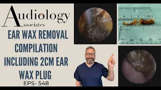 EAR WAX REMOVAL COMPILATION INC 2CM EAR WAX PLUG - EP548