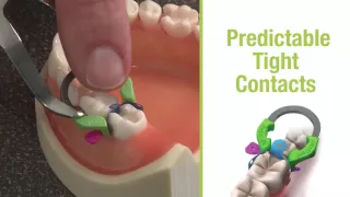 Triodent V3 System: Reliable Class II Restorations