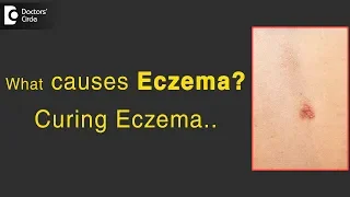 Eczema Causes, Types, Treatment | Eczema genetic factors | Is Eczema curable?