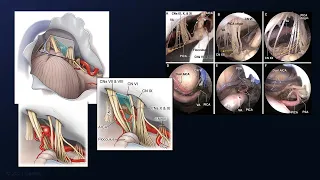 Clipping of a High-Riding PICA Aneurysm in the Glossopharyngo-Cochlear Triangle